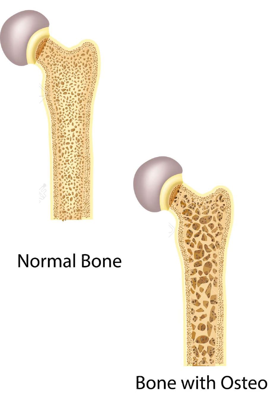 Bone of hip normal bone and bone with osteoporosis