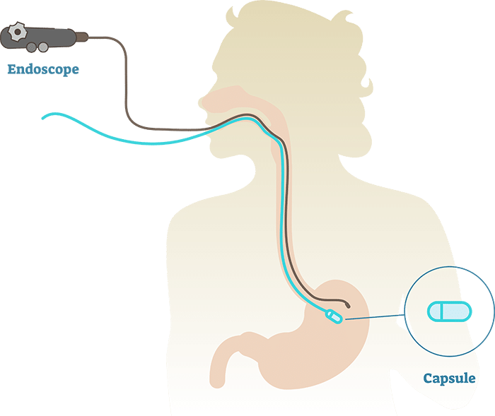 How the Gastric Balloon is inserted graphic