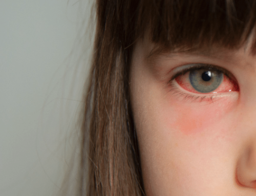 How Long Is Pink Eye Contagious? What You Need to Know